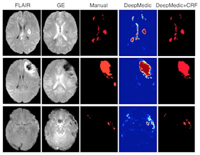 Comparison of delineations made manually and using deep-learning technology for traumatic brain injuries. Here, the delineations are again similar, despite the vast difference in time taken to make them by the human and by the machine.