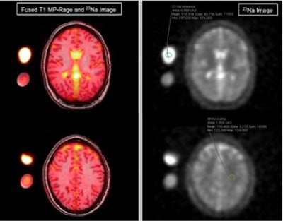 MRI examples of a migraine patient with exemplary region-of-interest placement in an external sodium reference phantom and in the white matter (right image). Left: fused T1-MP-RAGE and sodium image; right: sodium image. Images courtesy of RSNA.