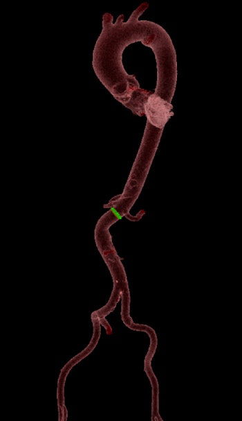 A 3D reconstruction of the whole aorta of a patient with atrial fibrillation. All images courtesy of Dr. Stefano Fiore, University Radiology Department, A.O.U. Citta della Salute e della Scienza di Torino, Molinette Hospital, Professor Paolo Fonio.