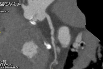 Reconstruction of the coronary arteries in a patient with atrial fibrillation.