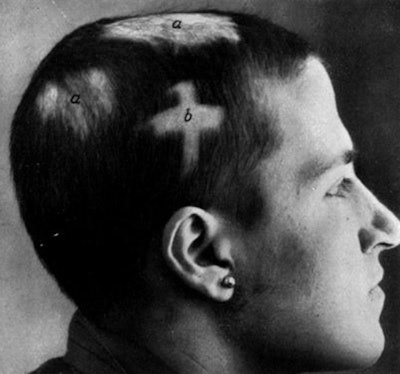 The photo shows a patient with tinea capitis, or ringworm of the hair, which was a common infection in the 1920s. Patients were treated with x-ray to the skull. Image from paper by Dr. Adolf Druckmann, 1932, courtesy of Dr. Jacob Sosna.