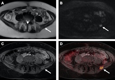 Images are from the January 2017 study of a patient with recurrent breast cancer and a PET-positive bone metastasis of the left iliac wing, which can be identified on T2-weighted half-Fourier acquisition single-shot turbo spin-echo (HASTE) (A) as well as on diffusion-weighted imaging (DWI) (B, arrows). The identical tumor lesion shows moderate contrast-enhancement on T1-weighted volumetric interpolated breath-hold examination (VIBE) images (C) and can be detected with a higher conspicuity after image fusion on PET/MRI (D). All images courtesy of Dr. Johannes Grueneisen.