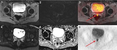 Images are from a 45-year-old woman with local recurrence of endometrial cancer. Postsurgical scar tissue is seen on a T1-weighted fast spin-echo (FSE) volumetric interpolated breath-hold examination (VIBE) (1) and T2-weighted FSE half-Fourier acquisition single-shot turbo spin-echo (HASTE) sequence (4). PET (6) and PET/MR (3) images show a small focus of pathologically increased FDG uptake in the dorsal part of the scar tissue, indicating local relapse. No focal contrast enhancement or tumor was detectable on T1-weighted FSE VIBE (1) and T2-weighted FSE HASTE (4). The local recurrence did not exhibit a clearly focal restricted diffusion on diffusion-weighted MRI (2) and corresponding apparent diffusion coefficient map (5). Images courtesy of Dr. Lino Sawicki.