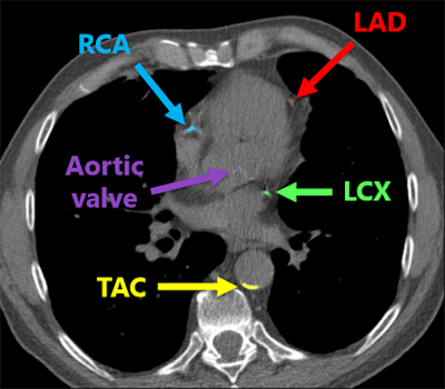 Deep-learning algorithm correctly detected and labeled calcifications on a routine chest CT scan. All images courtesy of Nikolas Lessmann.
