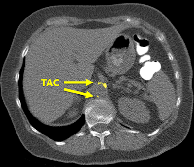The software correctly detected an example of thoracic aortic calcification near the base of the lungs.