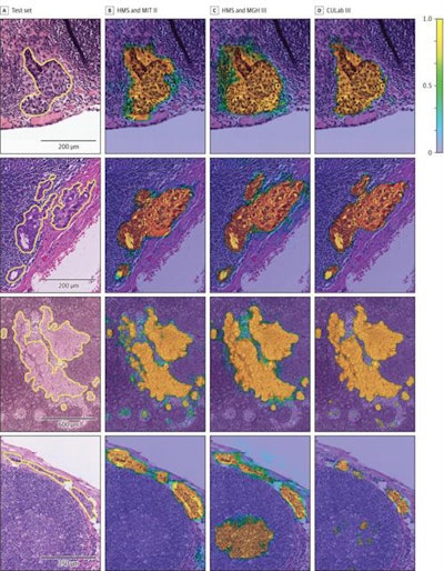 Images of lymph node tissue sections used to test the ability of the deep-learning algorithms to detect cancer metastasis. Image courtesy of JAMA