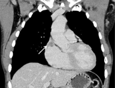 A 52-year-old man with endocardial metastasis located at the junction of vena cava superior. The patient was assigned to group 1.