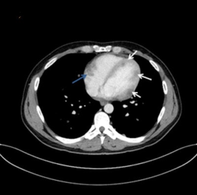 A 32-year-old man with multiple myocardial metastases (white arrows) as well as endocardial metastasis located in the right atrium (blue arrow). All images courtesy of Dr. Tanja Zitzelsberger and published in Cancer Imaging (1 July 2017, Vol. 17:1, pp. 19).