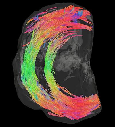 The 3D MR image offers a horizontal view across the cervical canal and reveals encircling fibers, which give support to the fetus and prevent it from entering the birth canal too soon. Image courtesy of the University of Leeds.