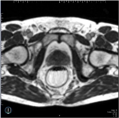 A clinical image of a prostate produced using a steady-state TrueFISP MR sequence acquired on a ViewRay 0.35-tesla MRIdian system in 25 seconds. Reprinted from Int. J. Radiat. Oncol. Biol. Phys. doi: 10.1016/j.ijrobp.2017.10.020 © 2017, with permission from Elsevier.