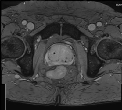 Rapid, accurate, automated segmentation algorithms are needed to handle large volumes of images that adaptive radiotherapy requires. Echo sequences optimized to better visualize the prostate can improve segmentation accuracy. Image credit: Maria Schmidt, Royal Marsden Hospital/Institute of Cancer Research. Reprinted from Int. J. Radiat. Oncol. Biol. Phys. doi: 10.1016/j.ijrobp.2017.10.020 © 2017, with permission from Elsevier.