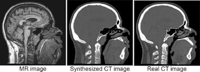 An example of a CT image derived from MRI using deep learning, with the real CT image aligned for reference (based on https://link.springer.com/chapter/10.1007/978-3-319-68127-6_2). The synthesized CT images closely match real reference CT images, potentially leading to a reduction in treatment planning time, patient discomfort, and CT radiation dose. This work was performed in collaboration with the radiotherapy department. All images courtesy of Jelmer Wolterink, PhD, and colleagues.