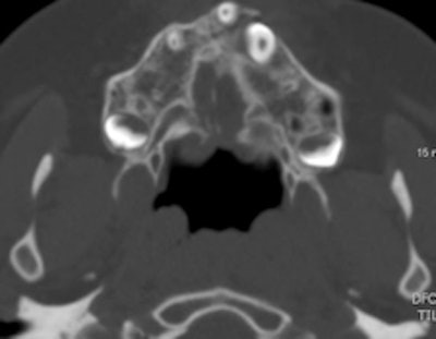 Axial CT scan after alveolar bone graft