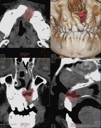 An 8-year-old girl with unilateral cleft lip and palate. Planar measurement (axial) and volumetric measurement before the alveolar bone graft (volume: 1.43 cc3).