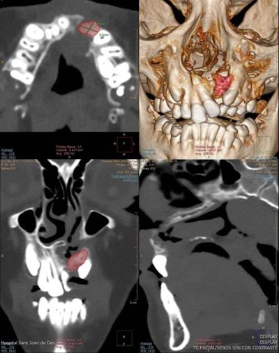 Same 8-year-old girl. Planar measurement (axial) and volumetric measurement after the alveolar bone graft (volume: 0.72cc3).