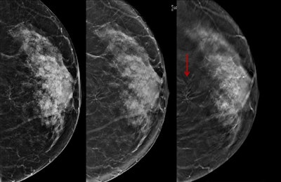 Architectural distortion in the left breast identified as invasive ductal carcinoma. Left to right: 2D mammography image, synthesized image, and DBT image. All images courtesy of Dr. Sara Romero Martín.