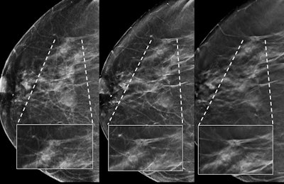 Spiculated nodule in the right breast identified as invasive ductal carcinoma. Left to right: 2D mammography image, synthesized image, and DBT image.