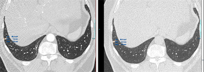 Top images: The semiautomatic lung nodule volumetry tools provides different volume and 2D measurements in different cardiac phases. In the first image, the volume measured is of 89.3 mm3 and in the second, is of 63.3 mm3. All images courtesy of Dr. Diana Penha. Bottom images: The semiautomatic lung nodule volumetry tools provides different volume segmentation that is aberrant in the first image. Due to this aberrant segmentation, the software provided different volumes and 2D measurements.