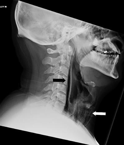 Lateral soft-tissue radiograph showed streaks of air in the retropharyngeal region (black arrow) and extensive surgical emphysema in the neck anterior to the trachea (white arrow). All images courtesy of BMJ Case Reports.