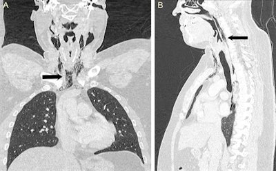 Coronal and sagittal CT scan of the neck and thorax confirmed the presence of surgical emphysema within the neck as well as pneumomediastinum extending from the skull base up to the T9 vertebra (black arrow).