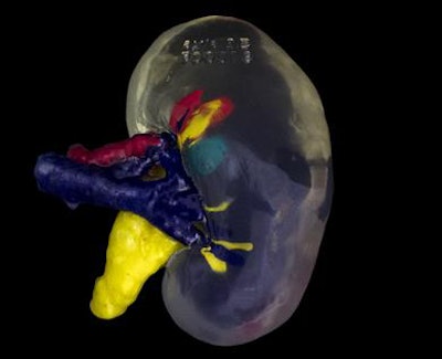 First image: A 3D-printed kidney model. Second image: Surgeons used a 3D-printed kidney as a visual aid for removal of a cyst from the actual kidney and subsequent kidney transplantation. All images courtesy of Axial3D.