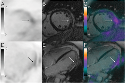 Images show concordant late gadolinium enhancement compared with FDG uptake on PET/MRI in a patient with biopsy-proven cardiac sarcoidosis. Images A to F illustrate short- and long-axis imaging of a concordant pattern of overlying inflammation and late gadolinium enhancement (fibrosis). Images A and D illustrate lateral FDG uptake (arrow), along with patchy epicardial and midmyocardial late gadolinium enhancement (images B and E; arrow). When fused (images C and F), the images offer an overlay of late gadolinium enhancement and FDG uptake (arrow highlighting the area of abnormality). Images courtesy of the European Heart Journal.