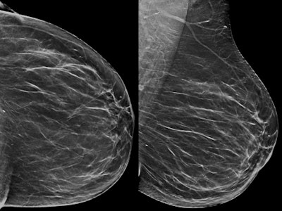 An example of architectural distortion detectable only on DBT. Above: A 54-year-old woman with no abnormality on synthesized 2D mammography. Below: Architectural distortion depicted on the left tomosynthesis (upper-outer quadrant) image. The microhistological examination after DBT-guided, vacuum-assisted biopsy revealed an invasive ductal carcinoma (grade 2), confirmed by surgical excision. All images courtesy of Dr. Francesca Caumo.