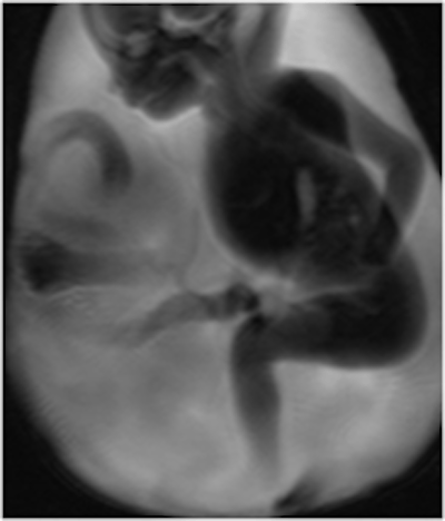 T2-weighted MR image of total aplasia of the hand