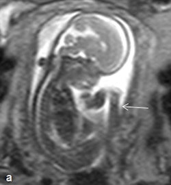 Fetus at 18 weeks