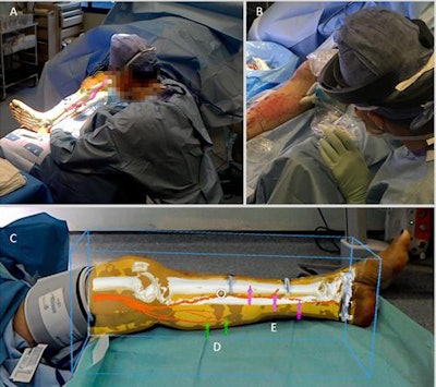 Surgeon's view of lower limb reconstructive surgery using a Microsoft HoloLens headset. Image courtesy of Dr. Philip Pratt et al.