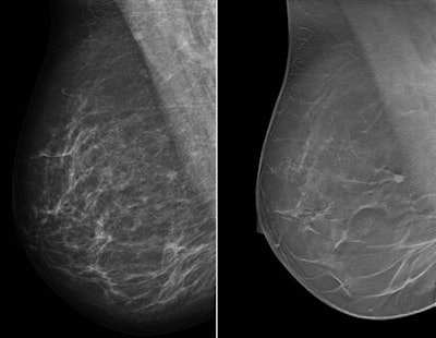 Single-view right MLO mammogram and corresponding DBT slice show the improvement in cancer visibility that can be achieved with tomosynthesis. There is a small cancer visible in the DBT slice just before the pectoral. The lesion is barely recognizable on the concurrent mammogram. All images courtesy of study co-author Dr. Ritse Mann.