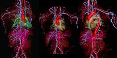 Three-dimensional images from MRA with ferumoxytol in a claustrophobic 35-year-old woman with a scanning time of six minutes and 57 seconds. Image courtesy of contributing author Dr. Paul Finn, also of UCLA.