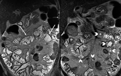 Coronal T2-weighted half-Fourier acquisition single-shot turbo spin-echo images at cavitating mesenteric lymph node syndrome in a case of refractory celiac disease, which display decrease in number of jejunal folds (arrows) along with cystic mesenteric lymph nodes (arrowheads). All images courtesy of Dr. Amir Reza Radmard.