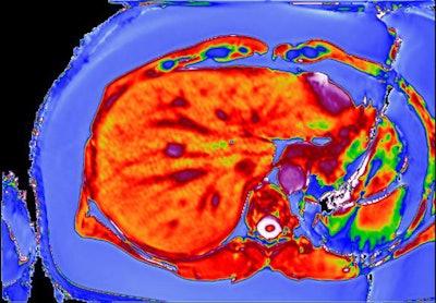 LiverMultiScan images of patient with fatty liver disease before (above) and after (below) bariatric surgery. Based on these scans, it was decided liver biopsy was not needed in this patient. Copyright Perspectum Diagnostics.