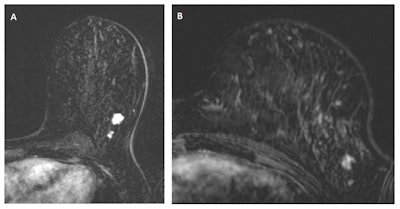 In 'A,' a multifocal tumor is detected in the left breast of a 49-year-old woman. 'B' depicts an MRI scan from the same breast, one year earlier. Despite the lower image quality and the difference in positioning (different scanner and coil), the cancer is clearly visible and should have been recalled according to the consensus read by the radiologists. Images courtesy of Drs. Suzan Vreemann and Ritse Mann.