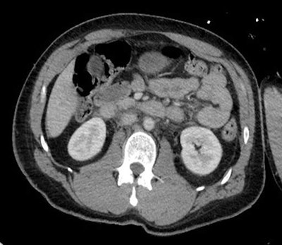 CT image depicts the 'inferior vena cava halo sign' with a thin rim of fluid surrounding the inferior vena cava in a fluid-resuscitated patient. Image courtesy of Dr. Stephen Power.