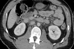 2018 02 23 16 54 8627 2018 02 22 Ct Ivc Halo Sign Thumb