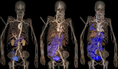 Arterial phase (left): Results after injection into arteries, with a leakage of contrast media in the pelvis and with presence of a hemorrhage in the right side of the abdomen (blue). Venous phase (middle): Major hemorrhage in the abdomen wall (shown in violet). Circulation phase (right): Presence of an additional hemorrhage in the right pleural space (shown in violet). All images provided by Alexandre Dominguez, CURML & HESAV.