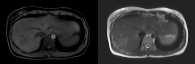 Example of an incidental finding in whole-body MR scan in population-based imaging without contrast enhancement showing an unclear T1-weighted hypointense (right panel), T2-weighted slightly hyperintense (left panel) liver lesion of about 4.5 cm in liver segment VII, which requires further workup. All images copyright Dr. Christopher Schlett.