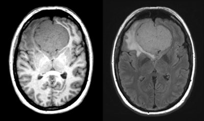 Example of an incidental finding in whole-body MR scan in population-based imaging without contrast enhancement showing an intracranial tumor mass -- T1-weighted isointense, T2-weighted slightly hyperintense, arising from the olfactory groove with significant local mass effect and moderate surrounding FLAIR signal hyperintensity within the left frontal lobe, most likely representing olfactory groove meningioma. Further workup and near-term neurosurgical consultation are necessary.