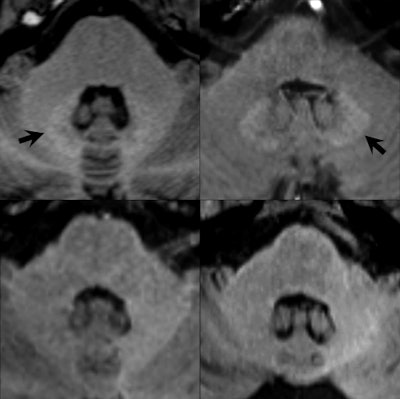 Unenhanced axial T1-weighted images through the level of the dentate nucleus in patients having 14 prior injections of gadopentetate dimeglumine (Magnevist, top left image), nine prior injections of gadobenate dimeglumine (Multihance, top right), six prior injections of gadobutrol (Gadovist, bottom left), and 10 prior injections of gadoterate meglumine (Dotarem, bottom right). Hyperintensity of the dentate nucleus (arrows) is seen as a residual after multiple injections of the linear agents gadopentetate dimeglumine and gadobenate dimeglumine (top images) but not after the macrocyclic agents gadobutrol and gadoterate meglumine (bottom images). Baseline images obtained before any contrast administrations (not shown) were normal in all four patients. Images provided by Dr. Alexander Radbruch, head of neuro-oncologic imaging at University Hospital Heidelberg in Germany, and published in Investigative Radiology, June 2017, Vol. 52:6, pp. 317-323.