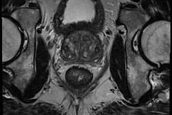 2015 02 17 12 14 24 990 2015 02 17 Prostate Cad Huisman Cad Validation Bottom