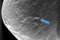 2018 03 01 00 11 1891 2018 03 01 Zackrisson Breast2 20180301004246