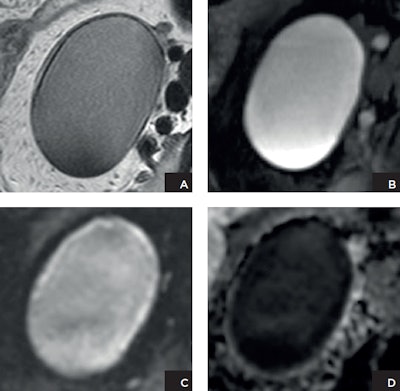 Patient with endometrioma. A: Axial T2-weighted high-resolution image shows a left adnexal lesion that demonstrates shading. The lesion is of high signal intensity on fat-suppressed T1-weighted image (B). Both the diffusion-weighted image (C) and the ADC map (D) demonstrate restricted diffusion. However, based on the anatomical images (A and B), the lesion can be confidently characterized as an endometrioma without any suspicious features for malignancy. This case highlights the pitfall of DWI as a nonspecific marker for cell density rather than tumor. Images courtesy of Dr. Evis Sala, PhD.
