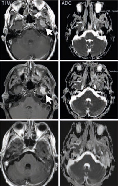 A middle-aged man with metastatic melanoma commencing on immunotherapy drugs nivolumab and ipilimumab. Pretreatment (top row) contrast-enhanced T1-weighted image shows an enhancing metastasis in the left temporal lobe (arrow), which is associated with low apparent diffusion coefficient (ADC) value (791 x 10-6 mm2/sec). After eight weeks of treatment, the lesion shows minimal change on the T1-weighted image (arrow) but demonstrates a 20% increase in the ADC value (948 x 10-6 mm2/sec). At 16 weeks after treatment (bottom row), the lesion has regressed and shows no appreciable enhancement on the T1-weighted image, although residual post-treatment high ADC value cystic area is visible. Image courtesy of Dr. Dow-Mu Koh.