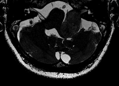 High-resolution T2-weighted (above) and enhanced T1-weighted (below) images of large intra- and extrameatal vestibular schwannoma. All images courtesy of Dr. Francesca Pizzini.