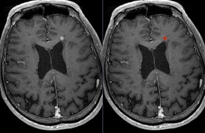 Postgadolinium T1-weighted image shows lesion (left: original image; right: lesion marked in red).