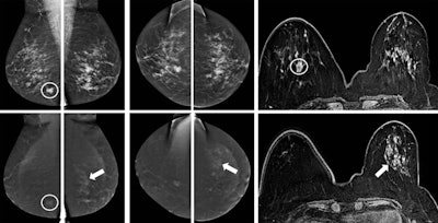 A 57-year-old woman was referred from a private clinic for an ill-defined irregular mass in the right breast, enhancing on both CESM and MRI (circles). CESM also showed diffuse enhancement throughout the left breast, for which random biopsies were taken, showing lobular carcinoma in situ (LCIS). Because of its extent, an MR-guided biopsy was recommended by the multidisciplinary team, again showing LCIS. Based on these findings and the patient's preference, a bilateral mastectomy with reconstruction was performed. Final pathology showed invasive carcinoma of no special type in the right breast, but 10 invasive lobular cancer foci varying from 3 mm to 10 mm in the left breast surrounded by LCIS. Images courtesy of Dr. Marc Lobbes.
