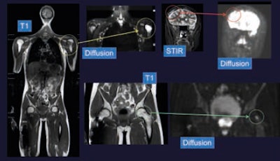 Ewing sarcoma, previous resections of the right femur and lumbar spine. Ewing metastases on this whole-body MRI are visible on T1-weighted and diffusion images in the left humerus, left femur, and right cranial vault. Images courtesy of Dr. Johan Bloem, PhD.