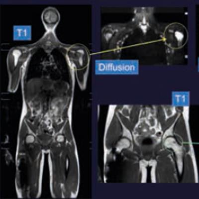 2018 03 03 19 11 3915 2018 03 04 Msk Tumors1 20180303193440